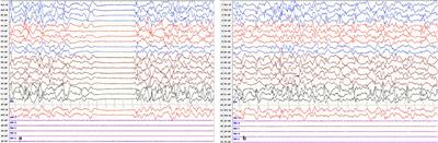 KCNQ2-Neonatal Epileptic Encephalopathy Complicated by Ventricular Tachycardia: A Case Report